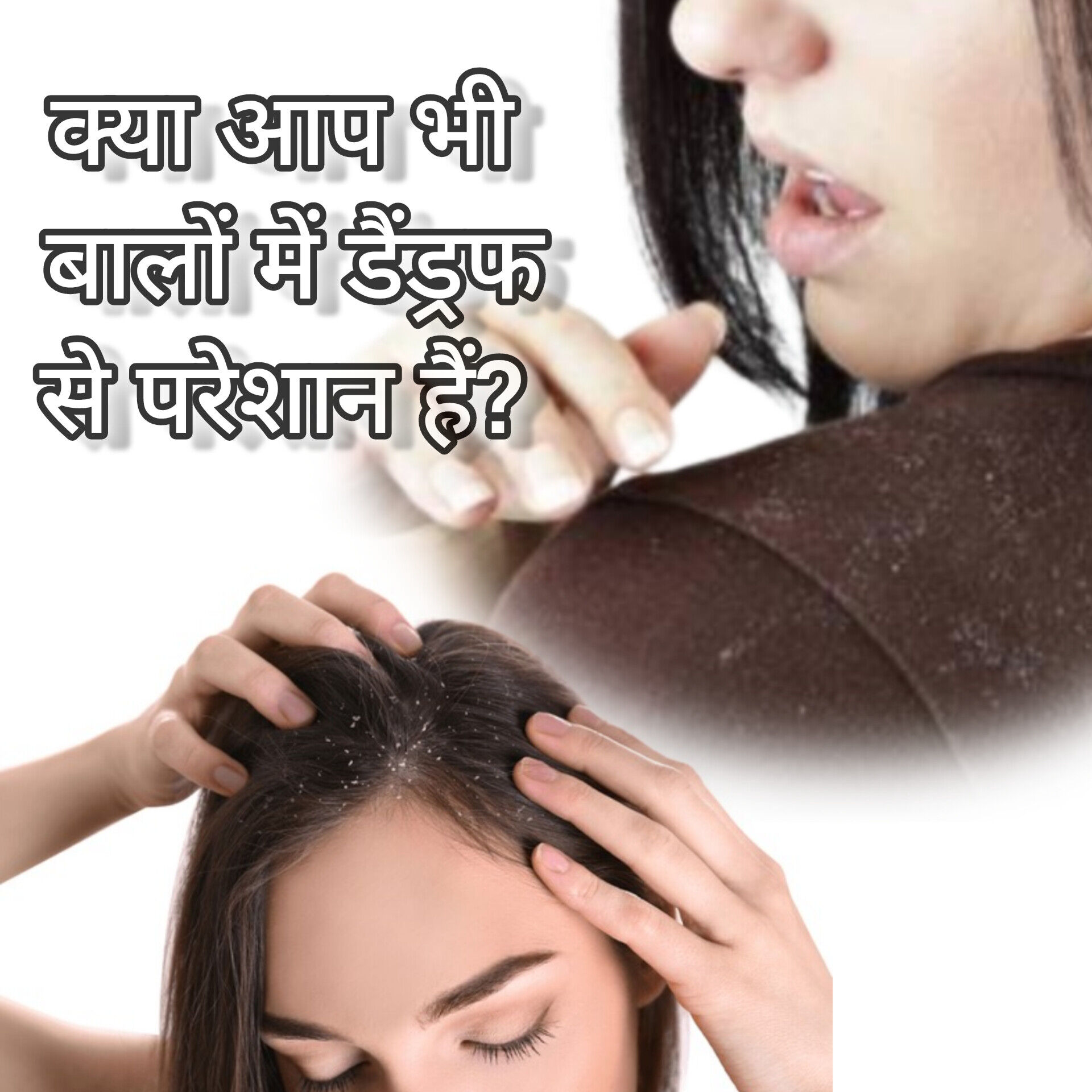 बालों में डैंड्रफ, कारण, लक्षण और घरेलू उपाय